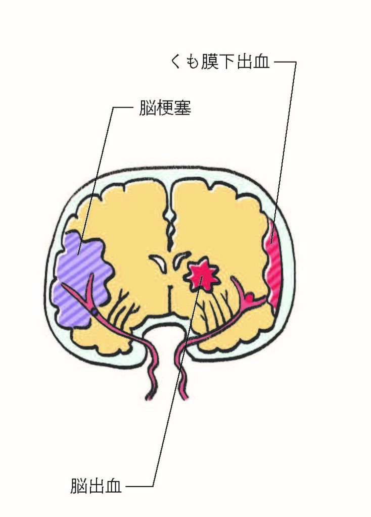 高血圧と脳卒中｜Next Stage｜三越伊勢丹健康保険組合